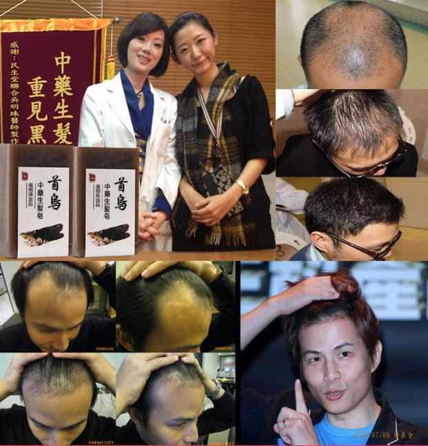 【最後一波現貨！！】【憲哥脫髮救星！ 】【拯救地中海】【10天就見效！ 1個療程頭髮增長1萬根】台灣吳明珠中醫師最新研發山葵何首烏中藥增發皂【雄性禿】【遺傳禿】【溢脂性脫髮】都有效【男女通用，拯救頭髮】